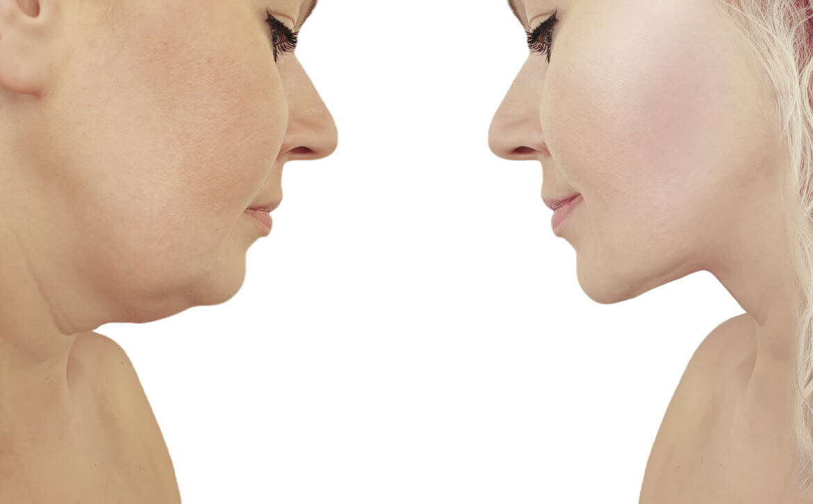 Liposuction Vs. Kybella Eliminate That Double Chin For Good